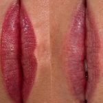 before and after lip filler healing