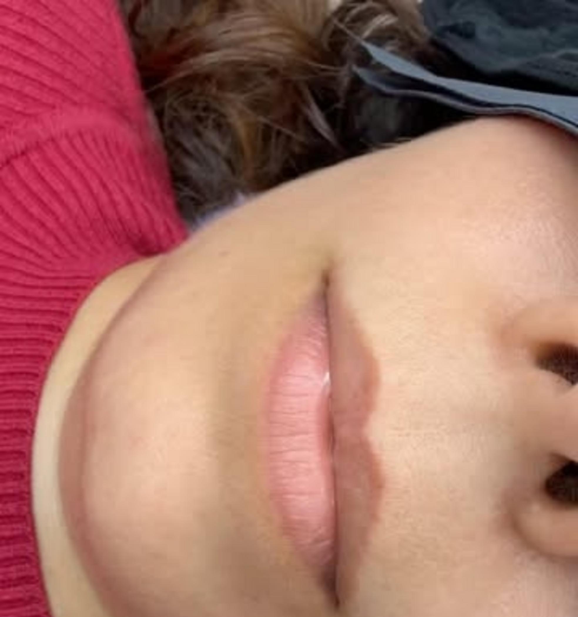 lip scar camouflage procedure photo